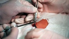 Dr. Kevinu Warwicku je osebni zdravnik med deset minut trajajočim posegom 24. avgusta 1998 v levo nadlaket vstavil 23 milimetrov dolgo in tri milimetre široko stekleno kapsulo z elektromagnetno tuljavo in nekaj mikroprocesorji. In kako je naprava delovala? Ko je profesor stopil skozi vrata, so mikroprocesorji oddali radijski signal, tuljava je zaradi signala proizvedla električni tok, ki ga je čip porabil za to, da je oddal identifikacijski signal. Zato so se pred dr. Warwickom odpirala vrata, prižigale luči, računalniki in gretje. Računalniško ustvarjen glas ga je pozdravljal in opozarjal na prejeto elektronsko pošto.