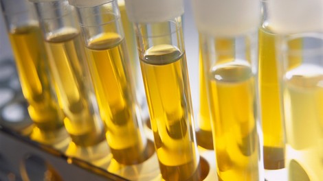 Britanski znanstveniki razvijajo urinski test za odkrivanje raka prostate