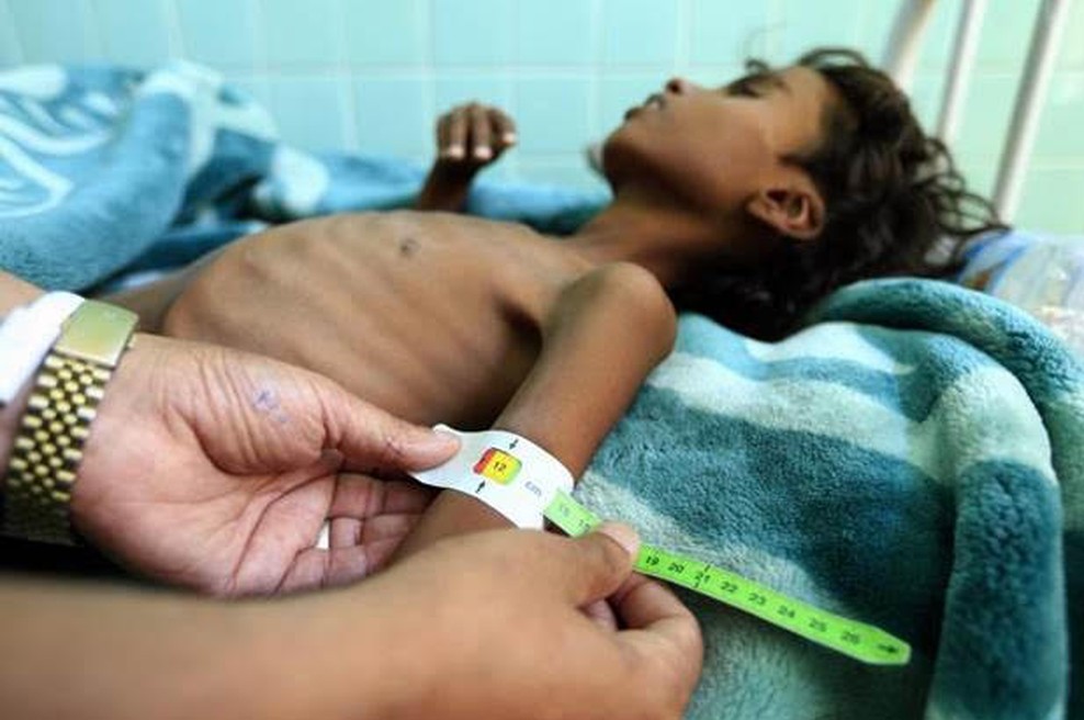 Katastrofalen vpliv pandemije COVID-19 na otroke v Jemnu (foto: UNICEF/Huwais)