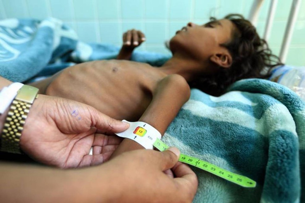 Rekordna podhranjenost v Jemnu - ogroženo preživetje milijonov otrok (foto: UNICEF/Huwais)