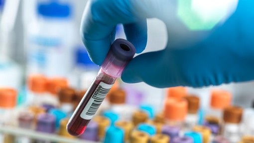 V postopku testiranja krvni test, s katerim bi lahko odkrili kar 50 vrst raka
