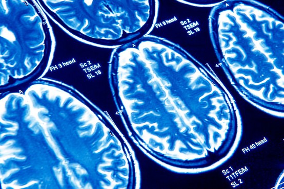 Covid-19 lahko povzroči trajne poškodbe možganov (zdaj pa tudi že vemo, zakaj)