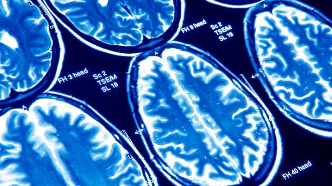 Covid-19 lahko povzroči trajne poškodbe možganov (zdaj pa tudi že vemo, zakaj) (foto: profimedia)