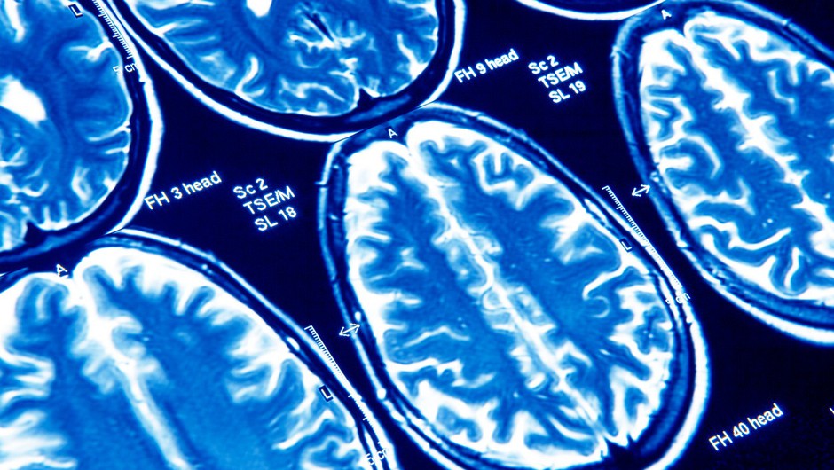 
                            Covid-19 lahko povzroči trajne poškodbe možganov (zdaj pa tudi že vemo, zakaj) (foto: profimedia)