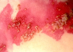 BioNTech in Pfizer želita s tehnologijo mRNA razviti cepivo proti pasavcu