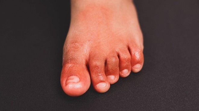 Omikronovi simptomi tudi s spremembami na koži: od rdečkastih izpuščajev do covidnih prstov! (foto: profimedia)