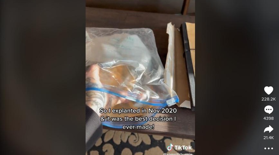 »Tako so 13 let kasneje videti prsni vsadki,« je objavila na TikToku in zgrozila vse (foto: xomgitsbunnie)
