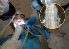 Neposrečen dogodek pri zobozdravniku, zaradi katerega je pacientka pristala na urgenci