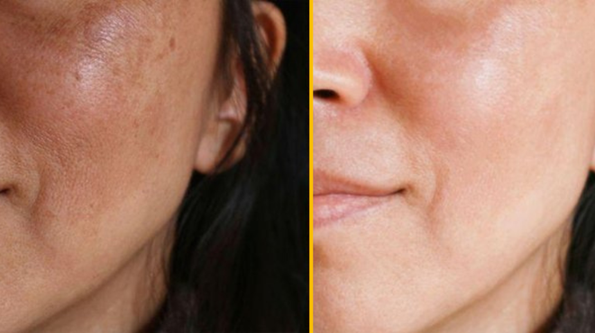 Imamo odgovore, kako lahko prepoznate melanom na svoji koži (foto: Shutterstock)