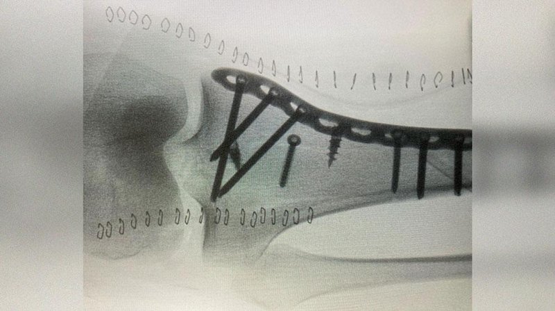 Rentgenska slika poškodovane noge Tine Robnik.