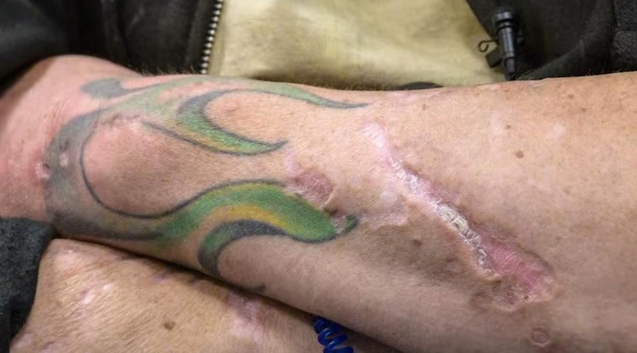 "Dobesedno poje tvoje telo" – nova 'zombi droga' straši po Ameriki, obstaja nevarnost, da se bo razširila v Evropo (FOTO in VIDEO) (foto: Posnetek zaslona)