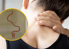 Kirurgi med možgansko operacijo doživeli šok: v glavi pacientke našli živega črva (gre za prvi primer v zgodovini)