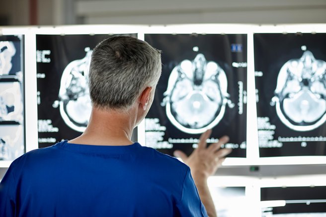 Skrb vzbujajoče: v možganih ljudi bistveno več mikro- in nanoplastike