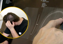 Študent se je po štirih dneh z zabave vrnil s čudnimi simptomi: zdravniki so v njegovi glavi našli ... kroglo