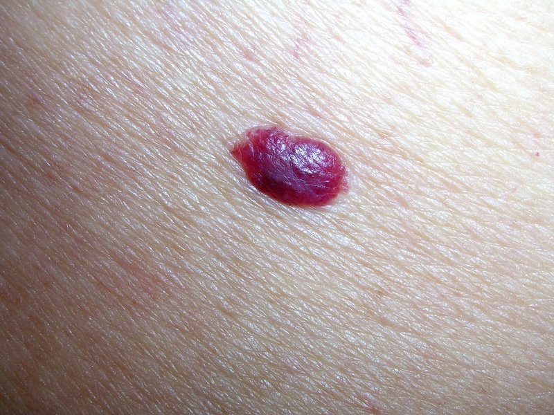 Cherry angioma - rdeče znamenje na koži