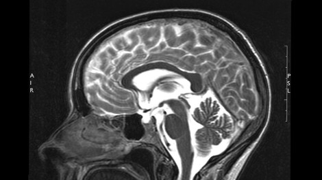 možgani slika mri zdravje
