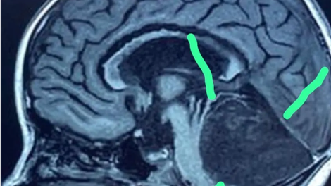 mri