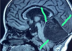 Zdravniki menili, da gre za tumor na možganih, kasnejše odkritje pa jih je pustilo odprtih ust