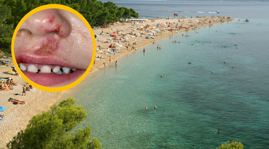 Pozor, če odhajate na Hrvaško: na plažah opažajo večje število primerov zelo nalezljive okužbe (foto: Profimedia/fotomontaža)