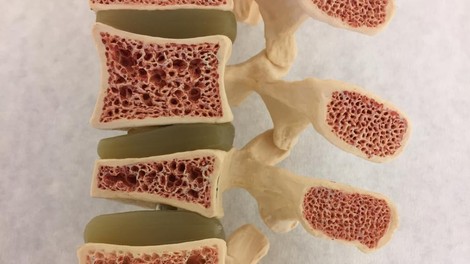Osteopenija – resno opozorilo pred osteoporozo