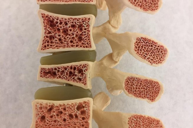 Osteopenija – resno opozorilo pred osteoporozo