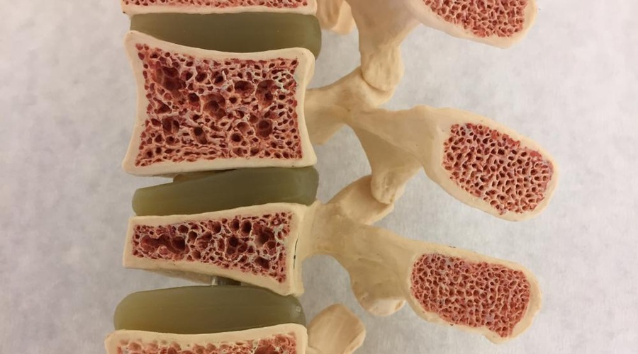 Osteopenija – resno opozorilo pred osteoporozo (foto: promocijska fotografija)