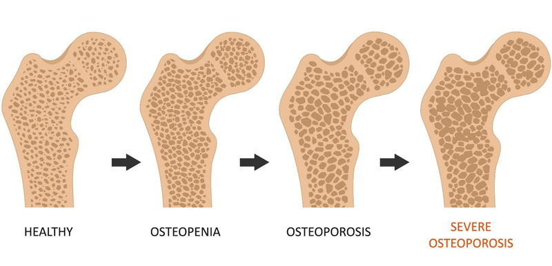 Osteopenija – resno opozorilo pred osteoporozo