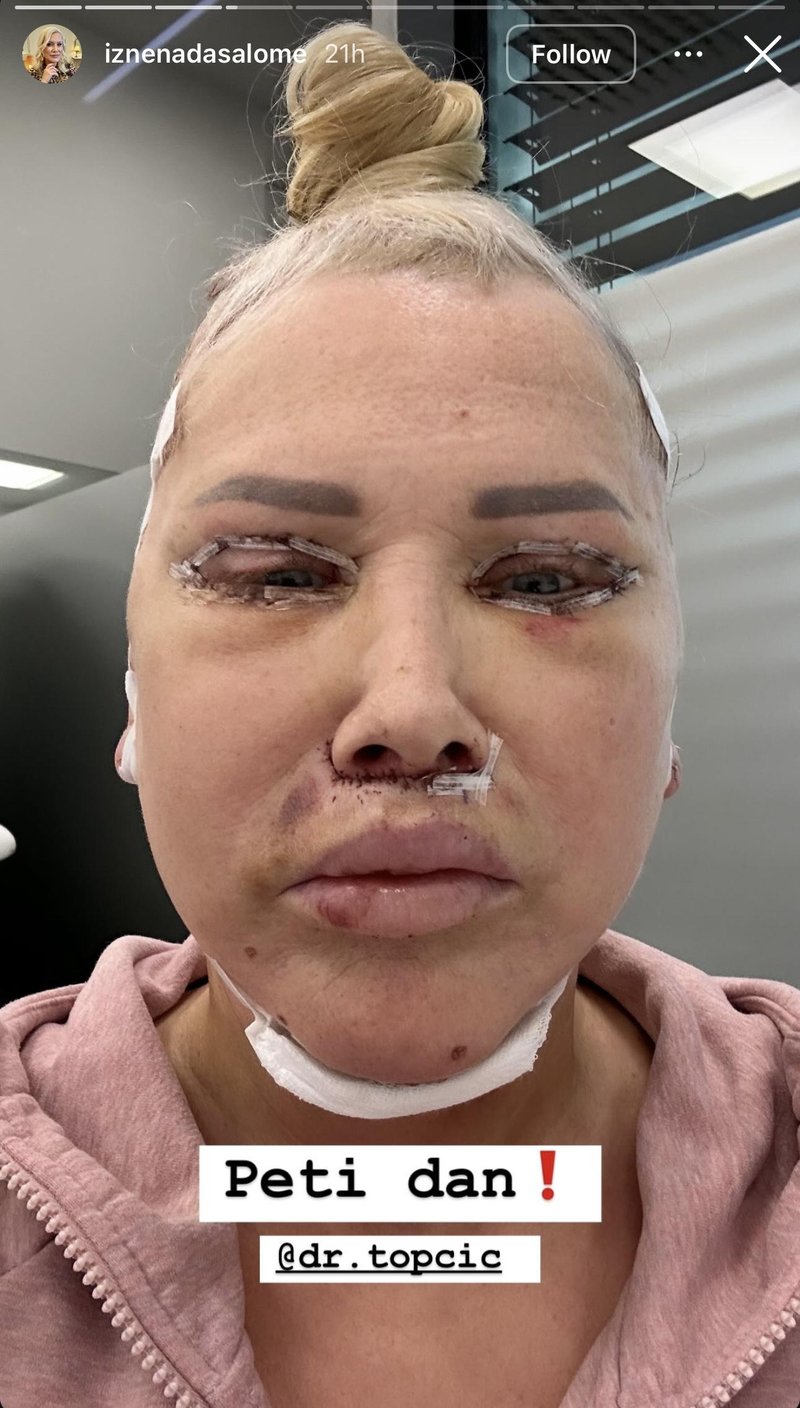 Salome lepotni poseg operacija kirurg