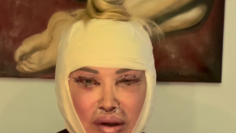 salome lepotna operacija lepotni poseg