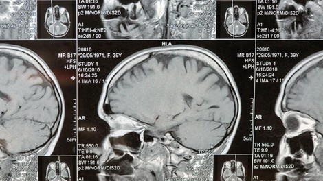 mozgani clovek umetna inteligenca znanost zdravstvo zdravje bolezni odkritje