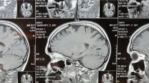Nevrokirurgi uporabili umetno inteligenco in obstali kot paralizirani: kar so našli v človeških možganih, spremeni vse,  kar smo vedeli