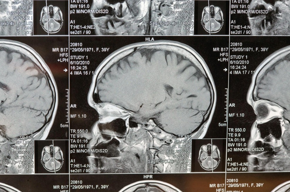Nevrokirurgi uporabili umetno inteligenco in obstali kot paralizirani: kar so našli v človeških možganih, spremeni vse,  kar smo vedeli (foto: Profimedia)