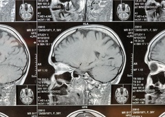 Nevrokirurgi uporabili umetno inteligenco in obstali kot paralizirani: kar so našli v človeških možganih, spremeni vse,  kar smo vedeli