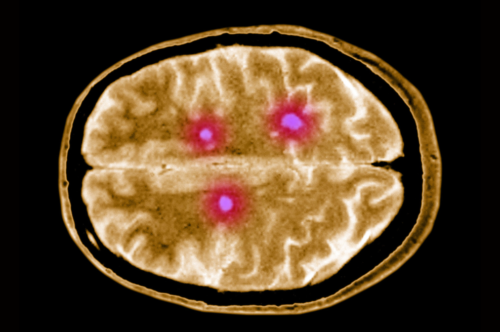 Neozdravljiva bolezen, ki prizadene možgane: to so simptomi, ki se lahko pojavijo že leta pred diagnozo (foto: Profimedia)