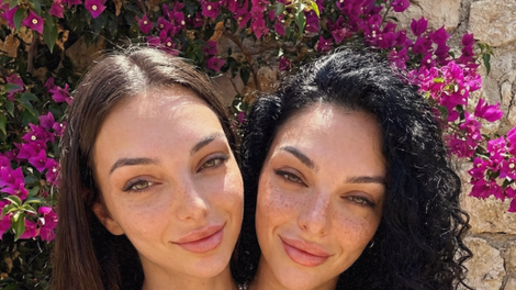 Siamski dvojčici, ki sta obnoreli svet: vsi se sprašujejo zgolj eno stvar in jasno je, da je nekaj hudo narobe