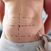 liposukcija