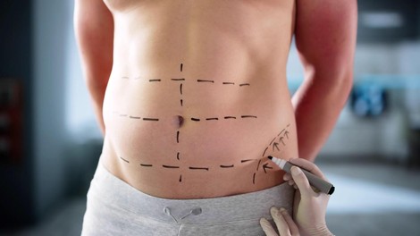 liposukcija