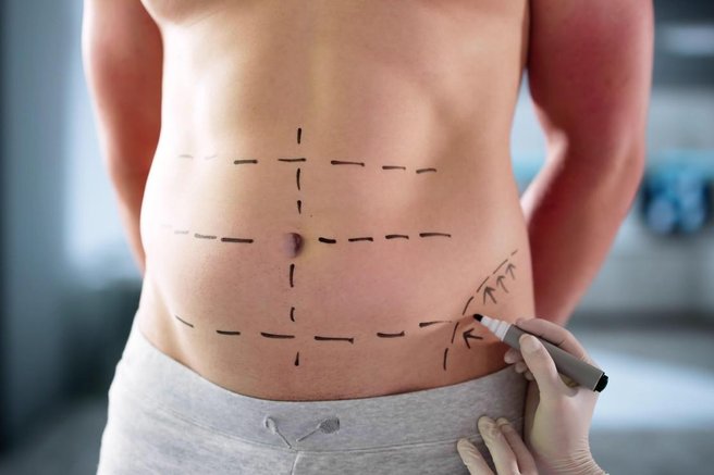 liposukcija