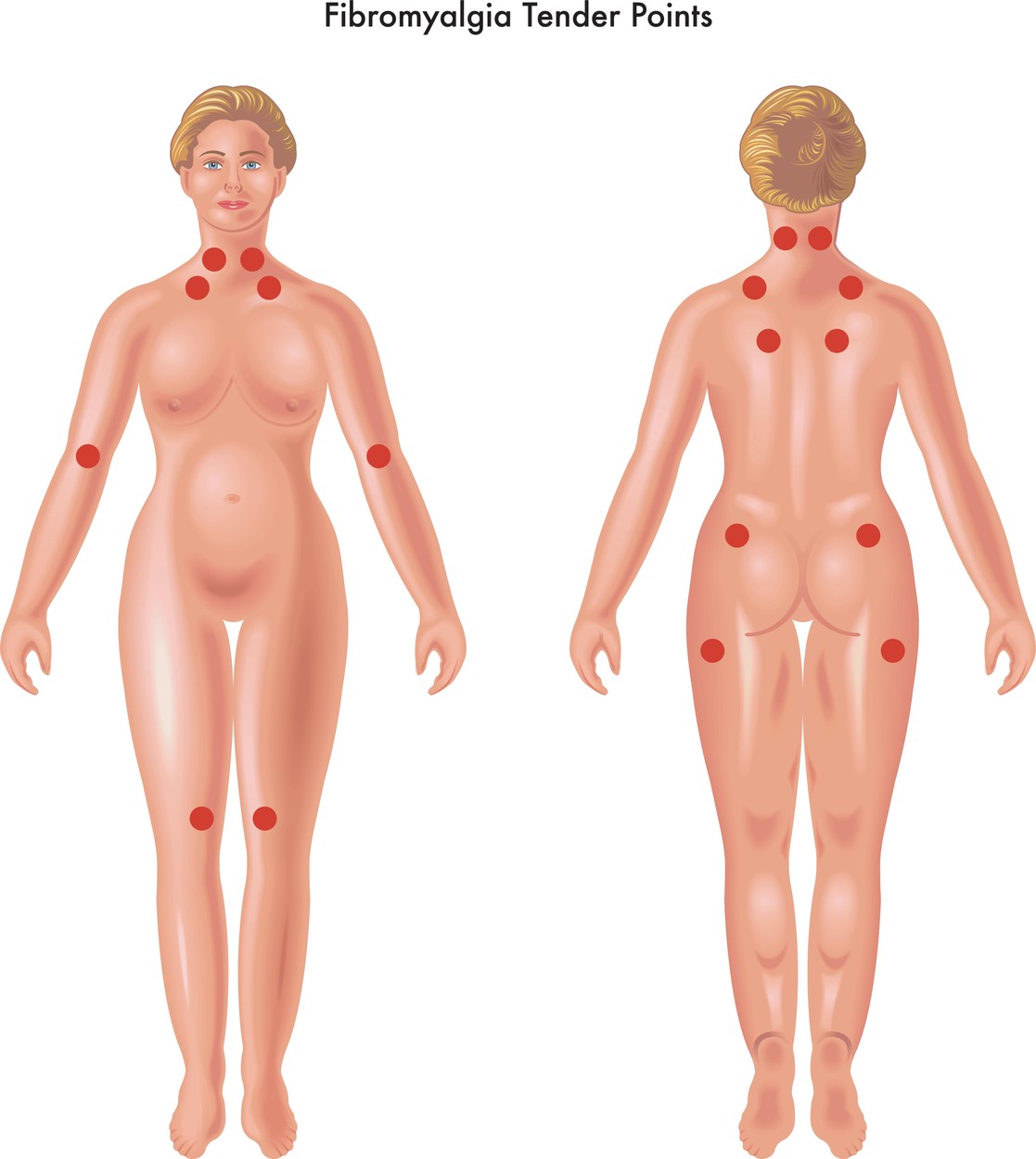 fibromialgija