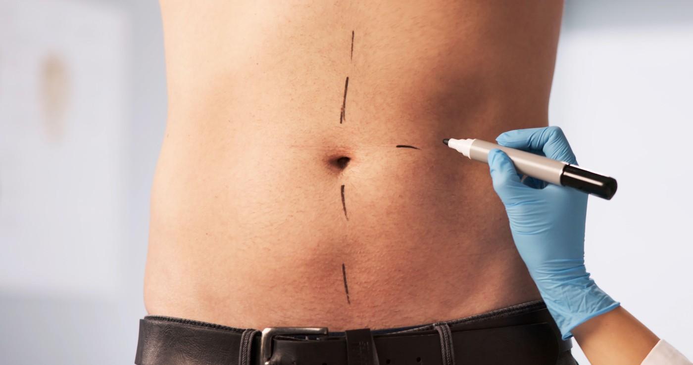 liposukcija